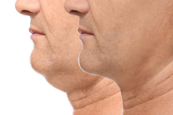 HIFU - Breakthrough in Anti - ageing 2 hifu results Leicestershire