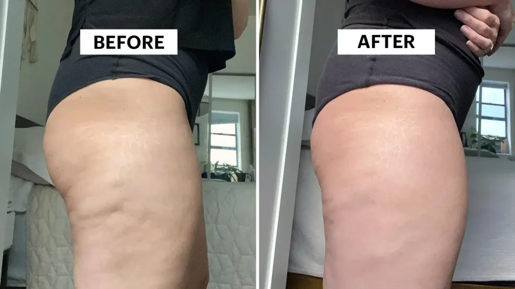 Do Toning Exercise Leicestershire Really Tackle Cellulite?