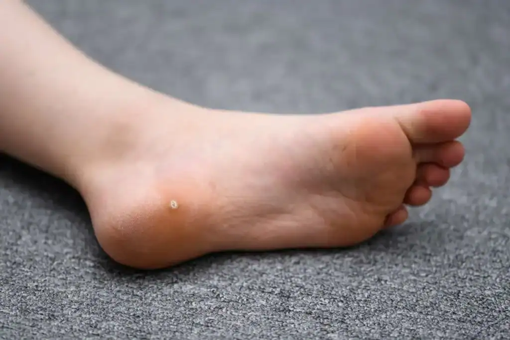 Cryotherapy For Warts And Also Verrucas 2 Image of verruca on the bottom of the foot that able to be treated with Cryotherapy Leicestershire