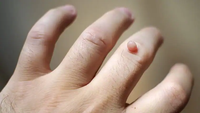 Image of blemish that Cryotherapy Leicestershire can remove with Lipo 360.