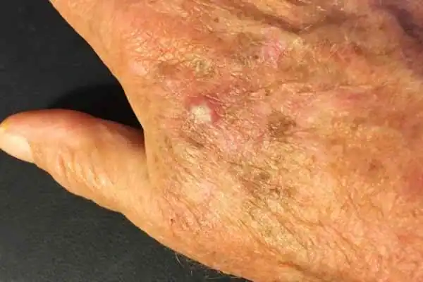 Cryopen For Actinic Keratoses 1 Image of Actinic keratoses Leicestershire on a person hand