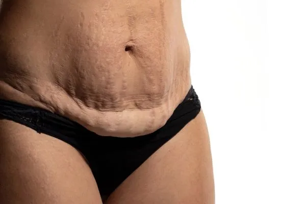 The science behind skin tightening Leicestershire picture of a woman's sagging skin on the stomach